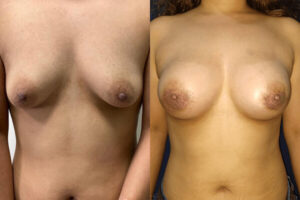 Patient before and after plastic surgery in Mexico