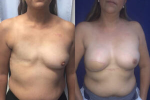 Patient before and after plastic surgery in Mexico