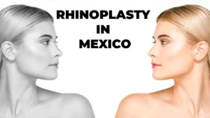 Read more about the article Rhinoplasty in Mexico: All you need to know