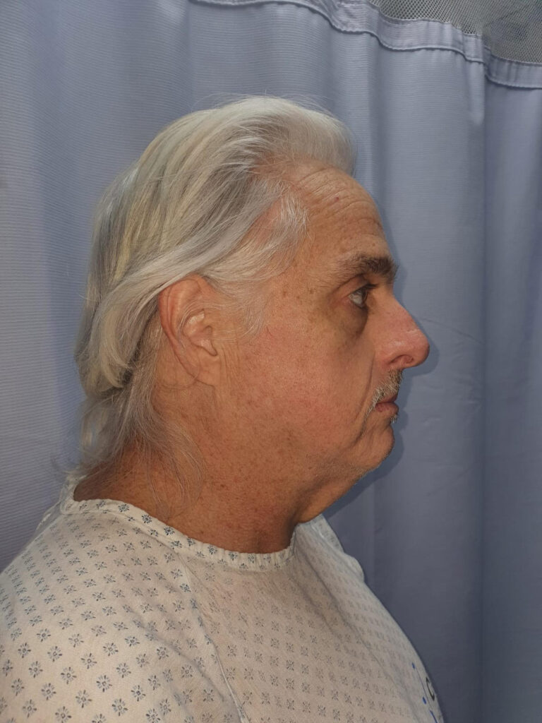 Image of before and after of neck lift