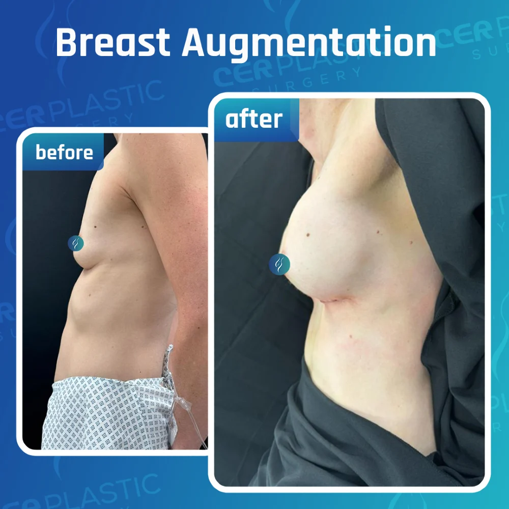 Breast procedures