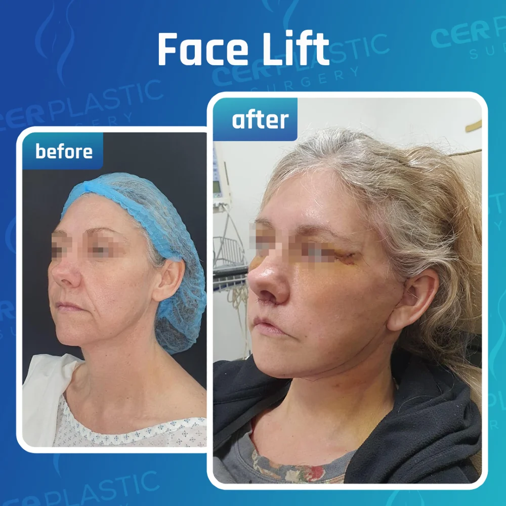 Face procedures