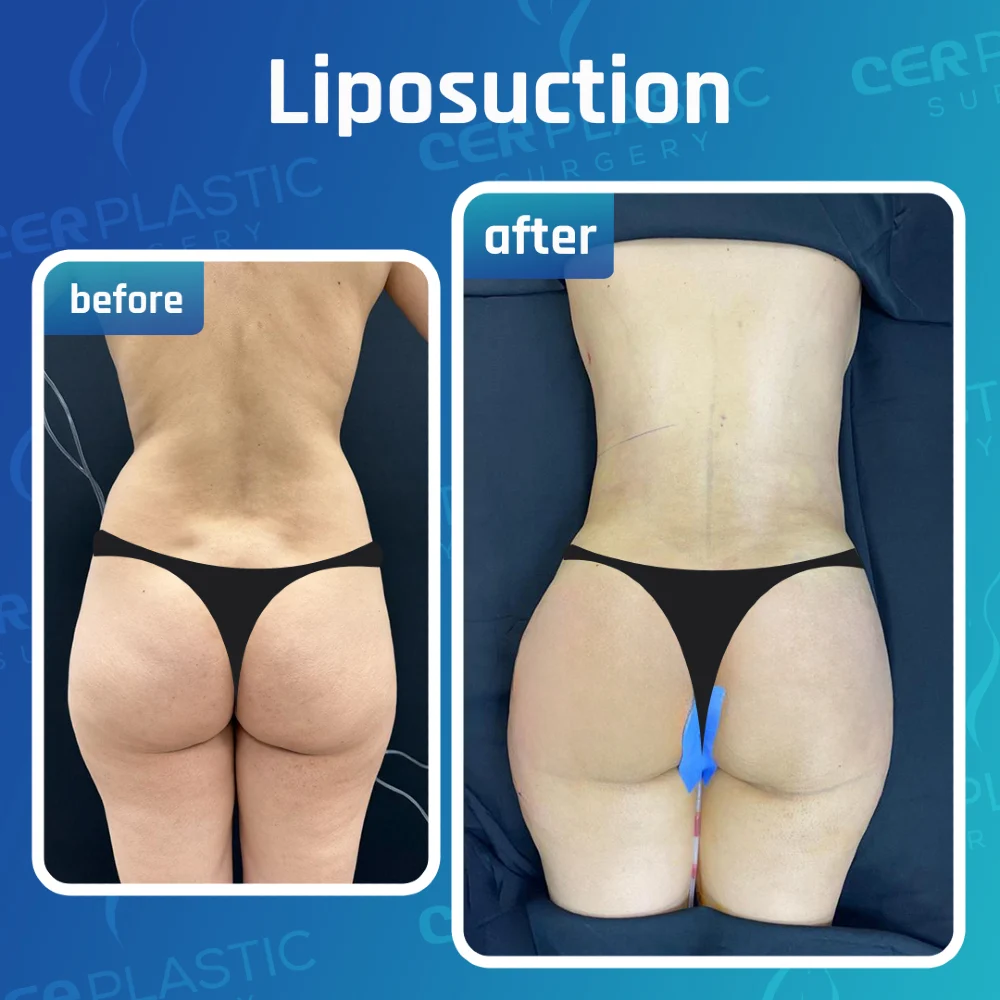 Body procedures