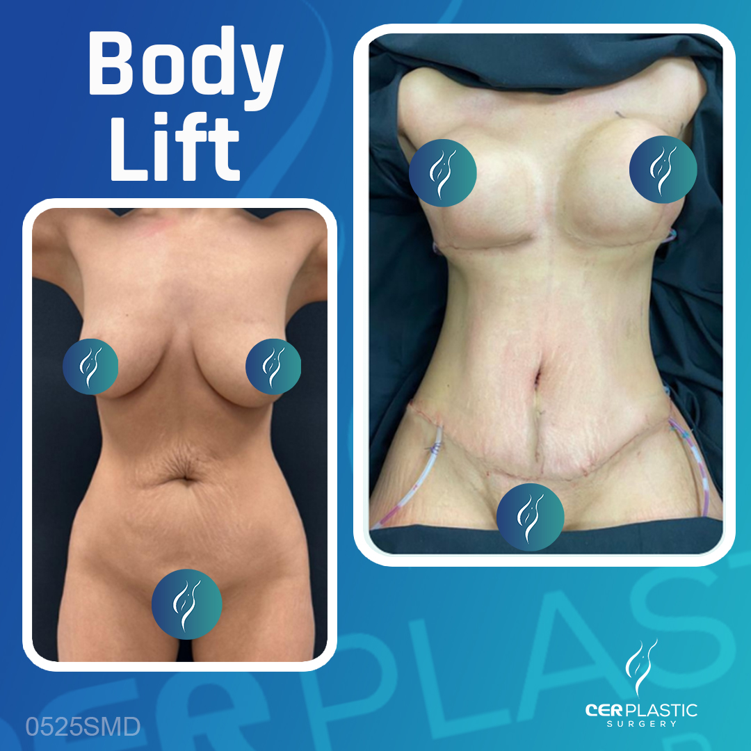 bodylift