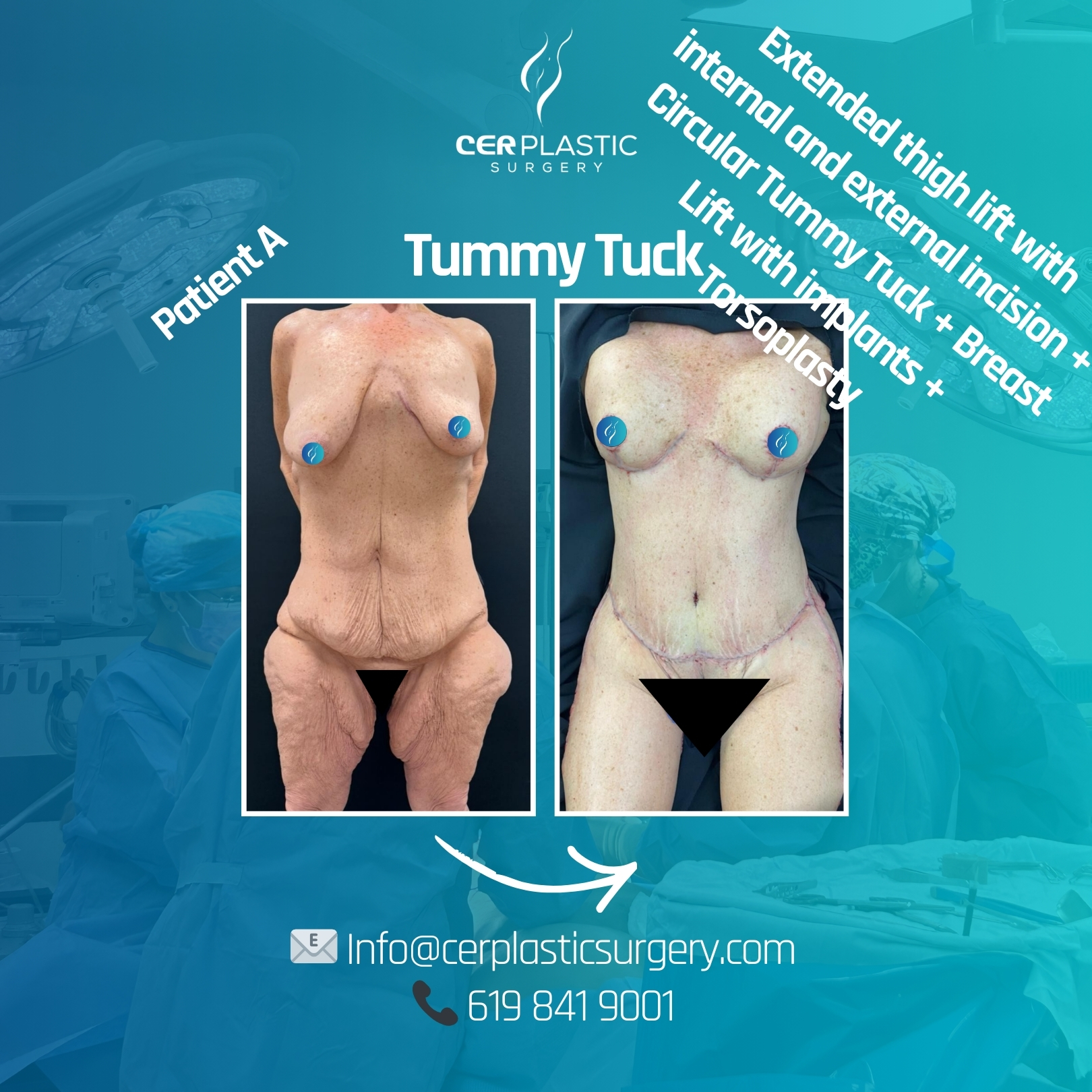 Tummy Tuck patient A front side plus extended thigh lift + breast lift with implants + torsoplasty