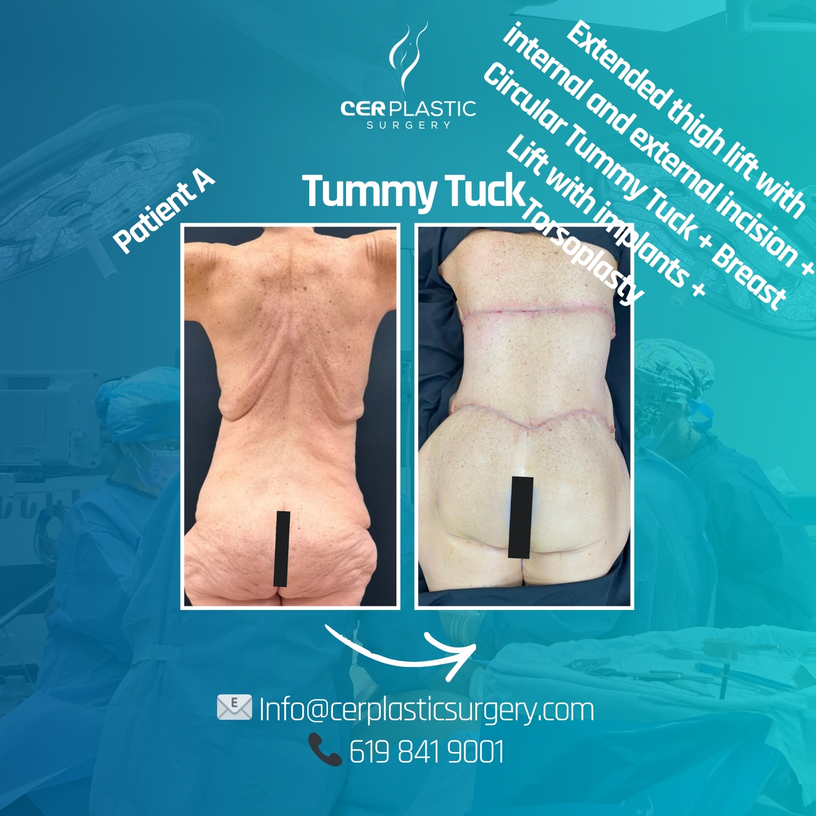Tummy tuck patient before and after back side