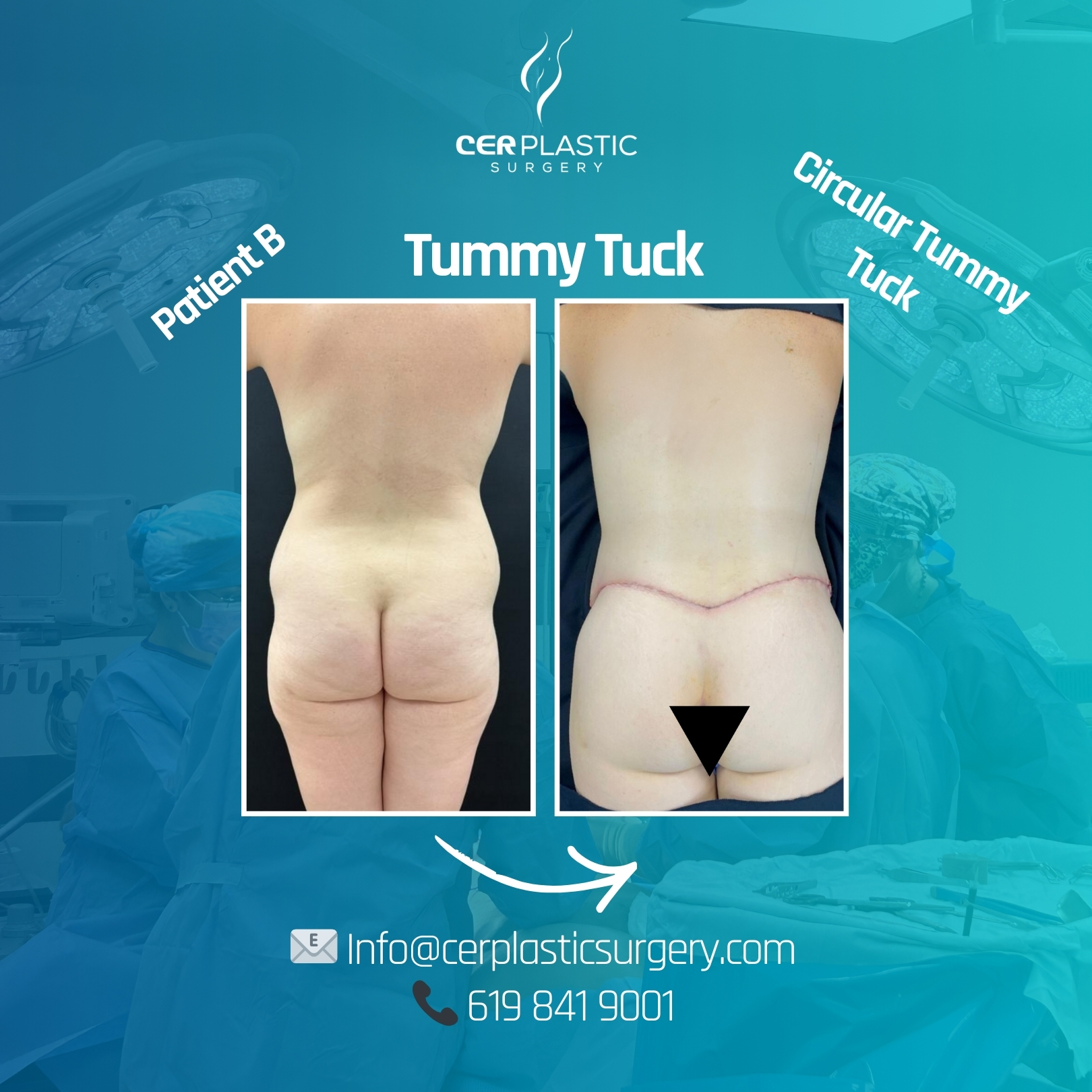 Tummy Tuck Patient B back side