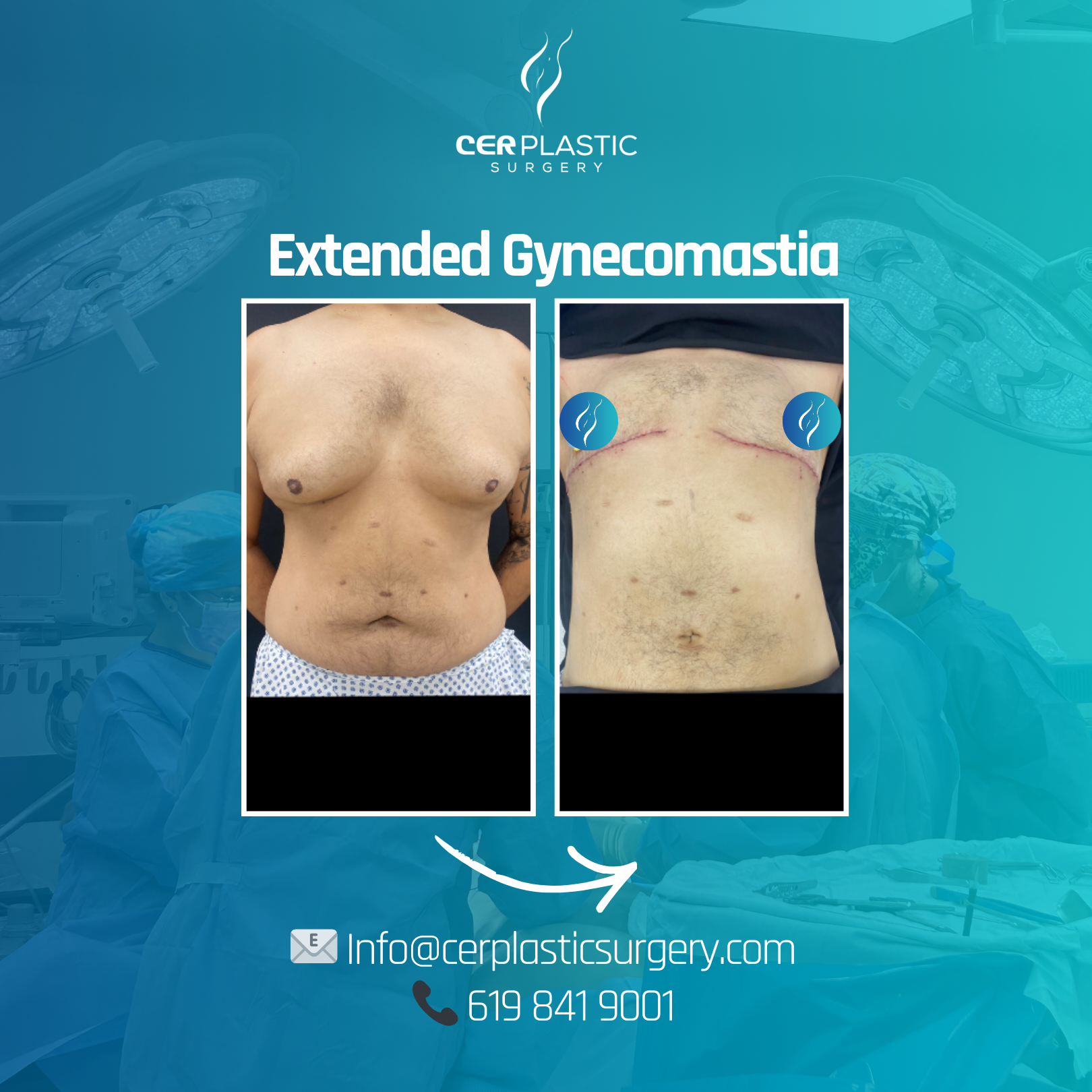 male patient before anf after extended gynecomastia