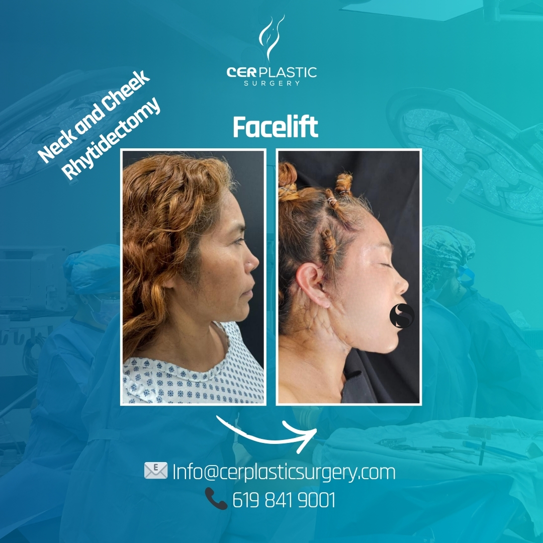 face lift before and after