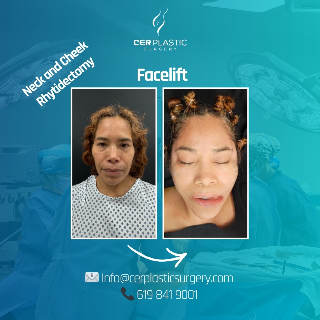 face  lift before and after front side
