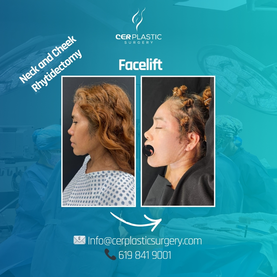 Face lift before and after