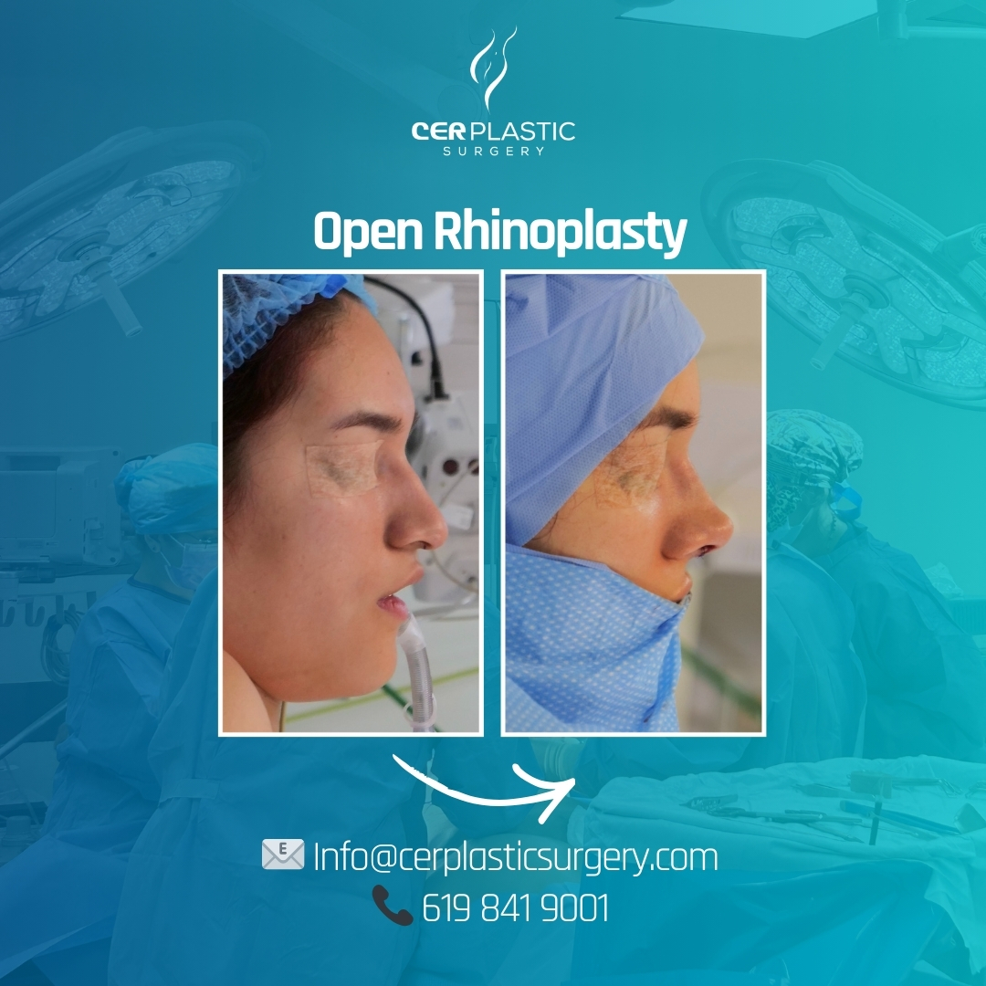 Open rhinoplasty before and after