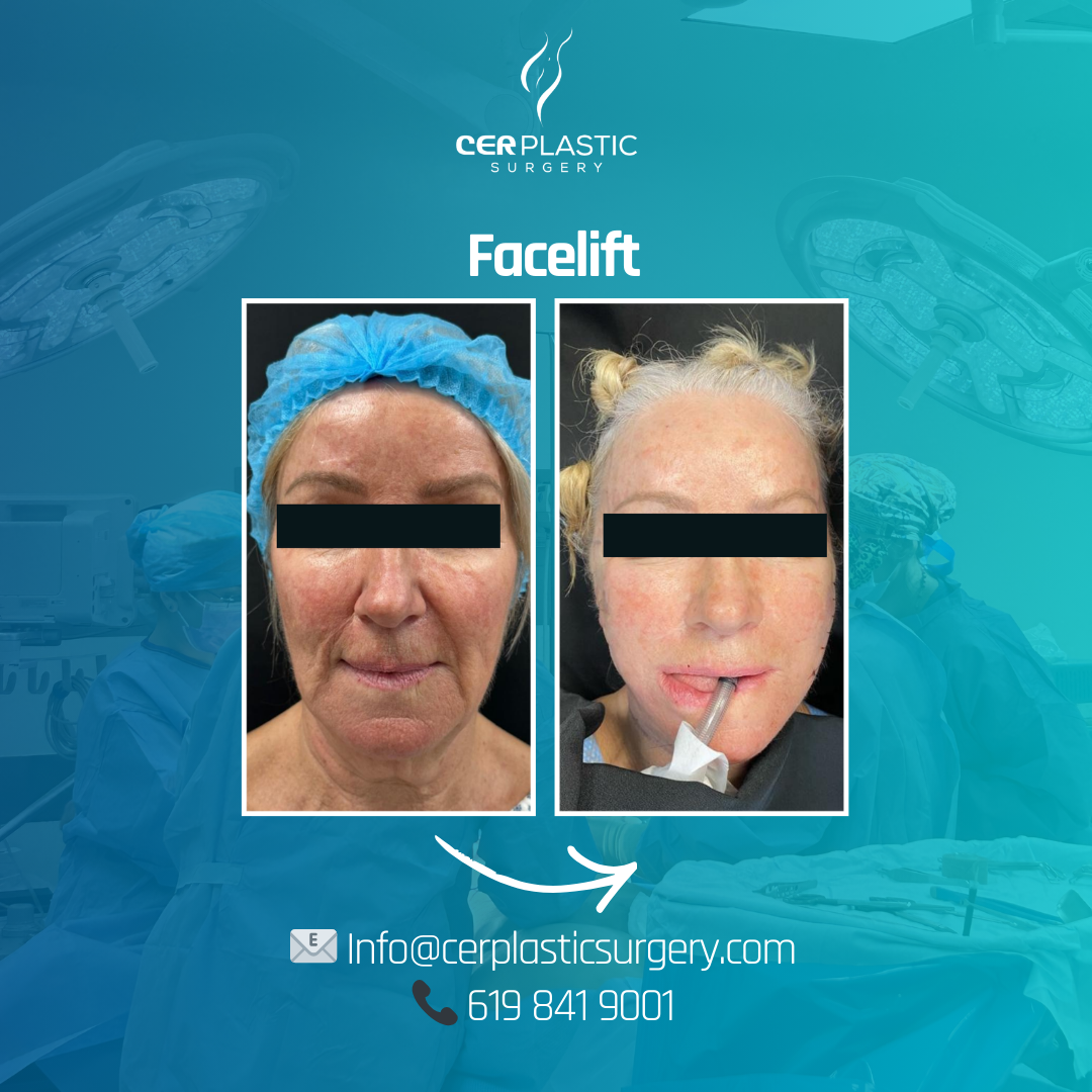 facelift before and after front side