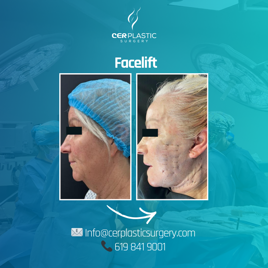 Face lift before and after