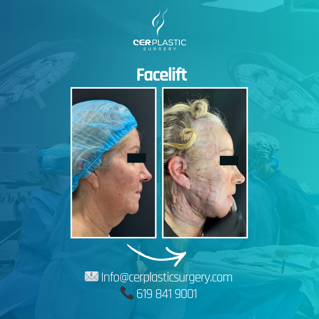 Face lift before and after right side