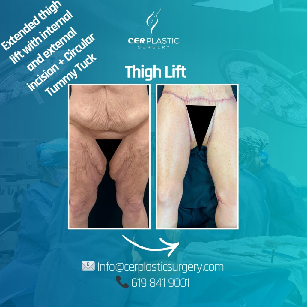 Patient thigh lift + tummy tuck cer plastic surgery left