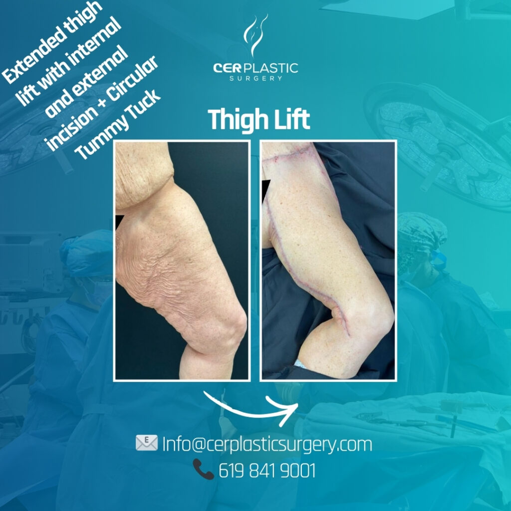 Patient thigh lift cer plastic surgery left