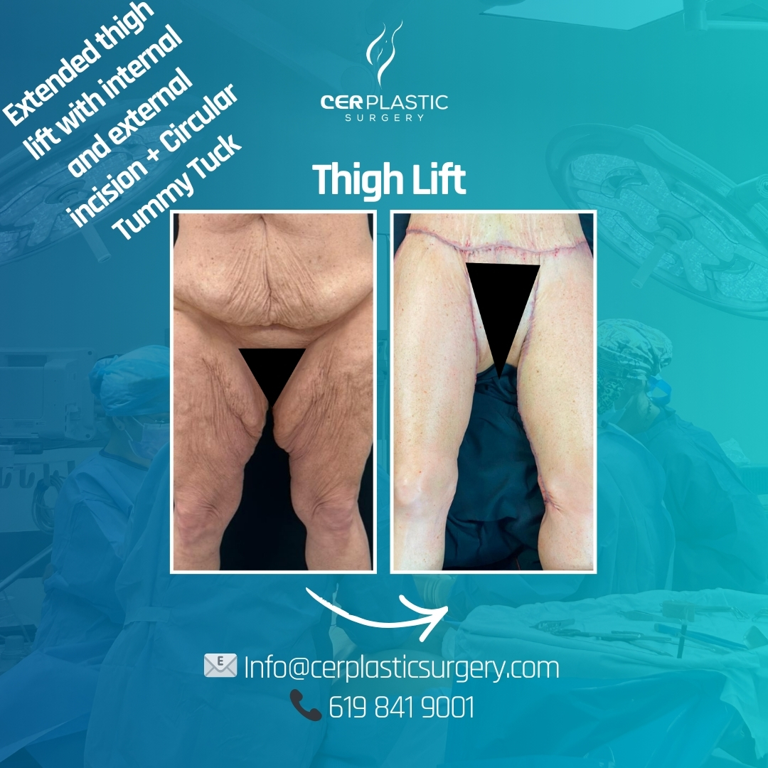 Thigh Lift before and after front side