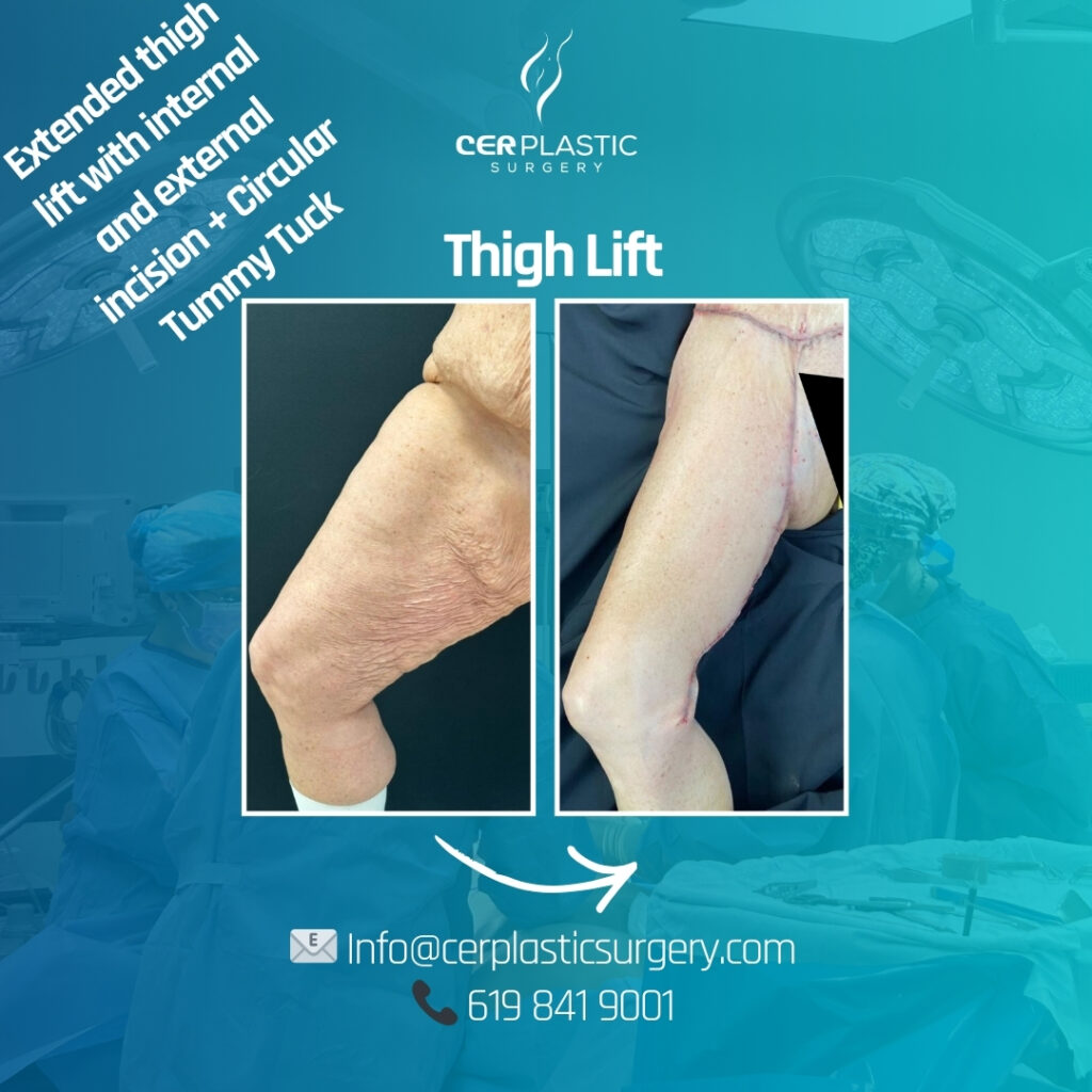 Patient thigh lift cer plastic surgery left