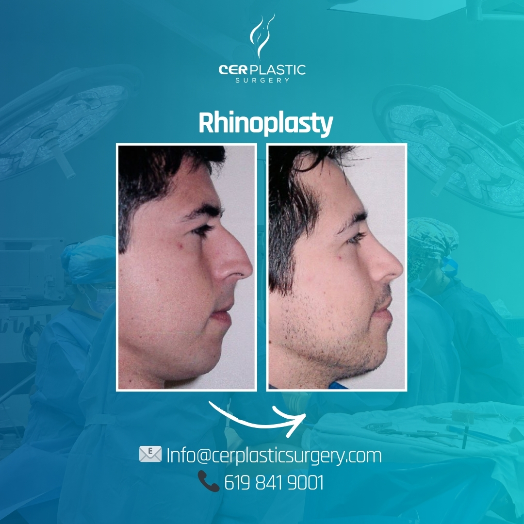 Rhinoplasty before and after