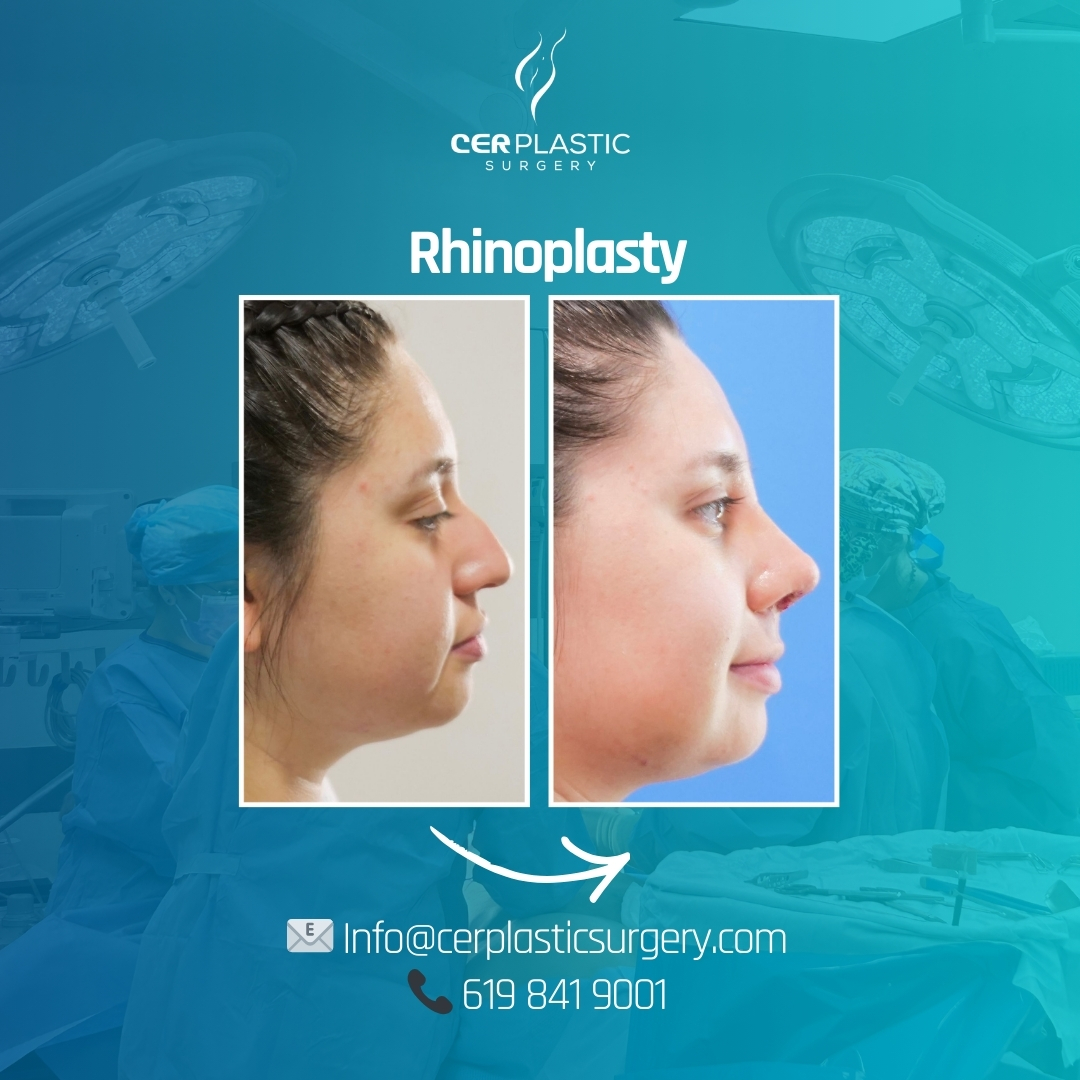 rhinoplasty before and after front side