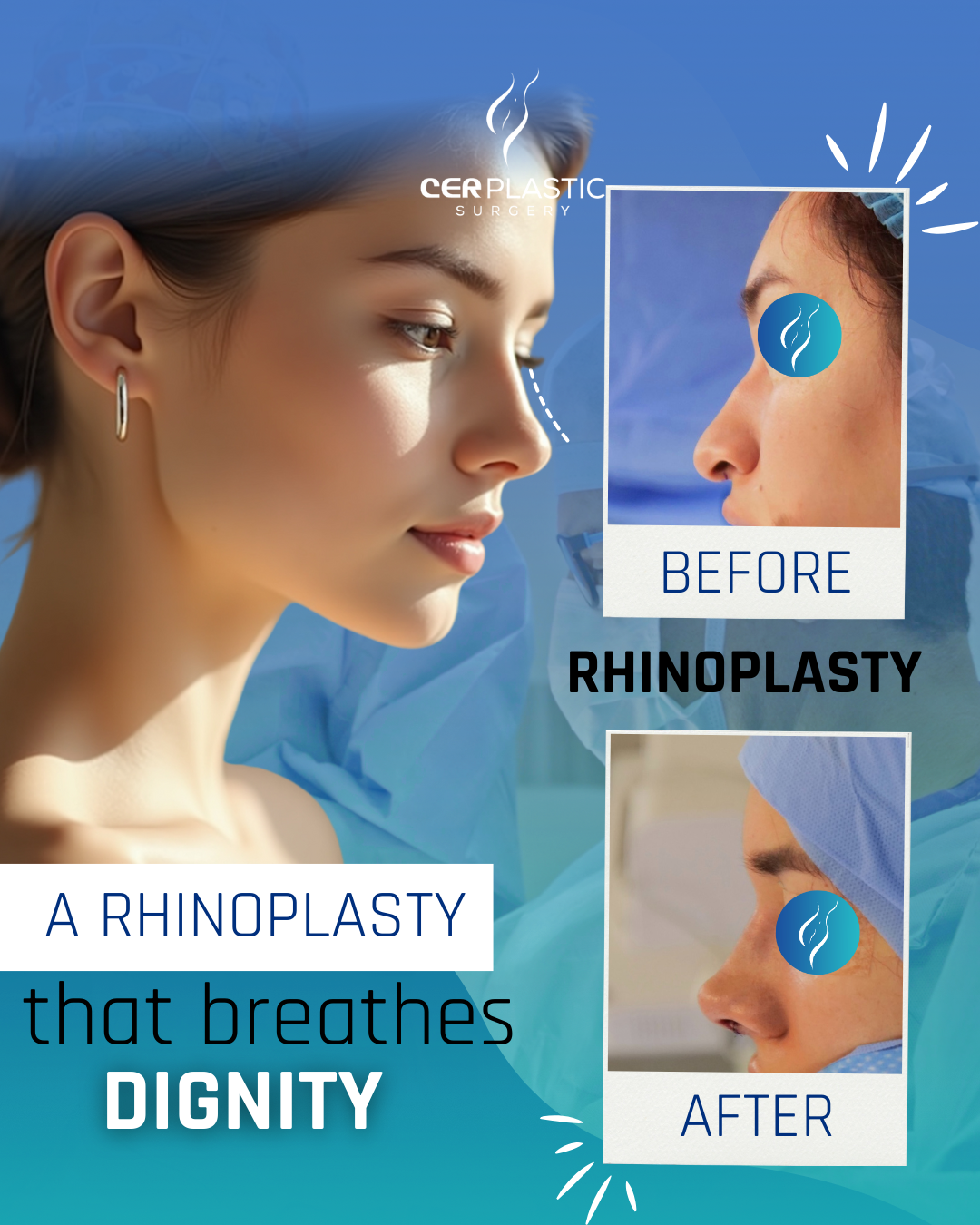 Rhinoplasty before and after