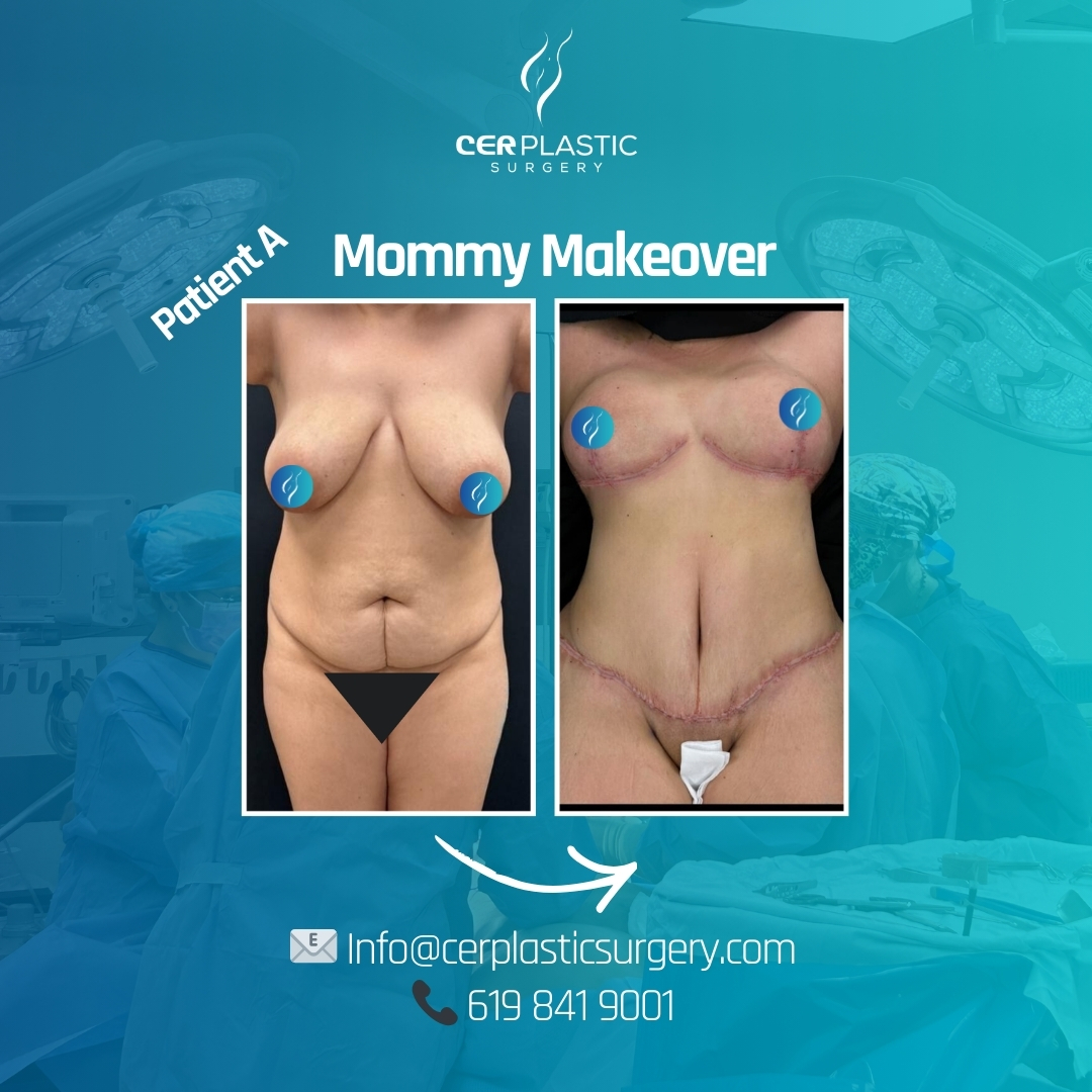 mommy makeover before and after patient a