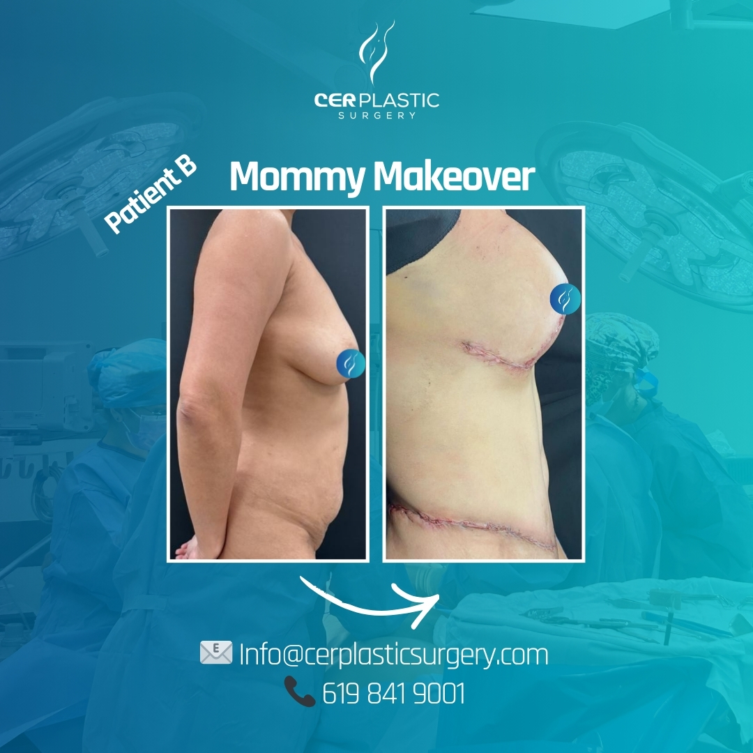 mommy makeover before and after patient b
