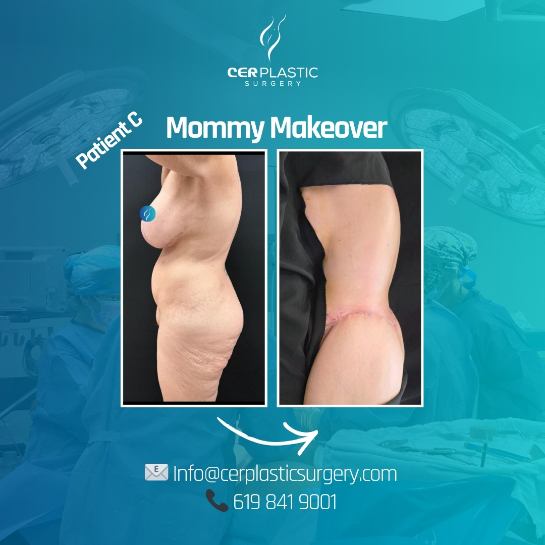 mommy makeover before and after patient c