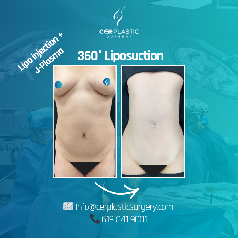 Image of a 360 liposuction