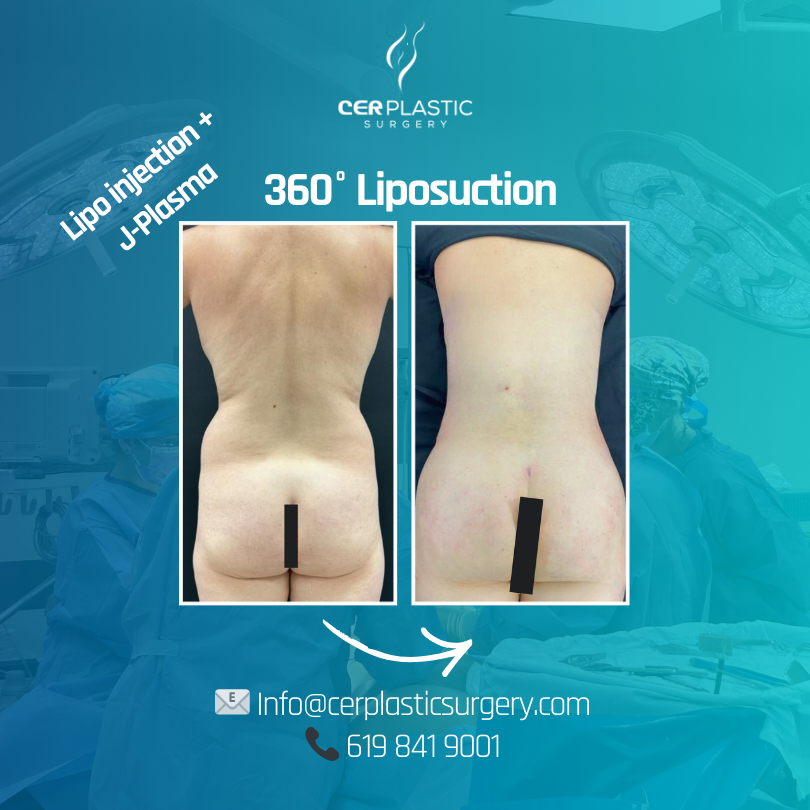 Image of a 360 liposuction