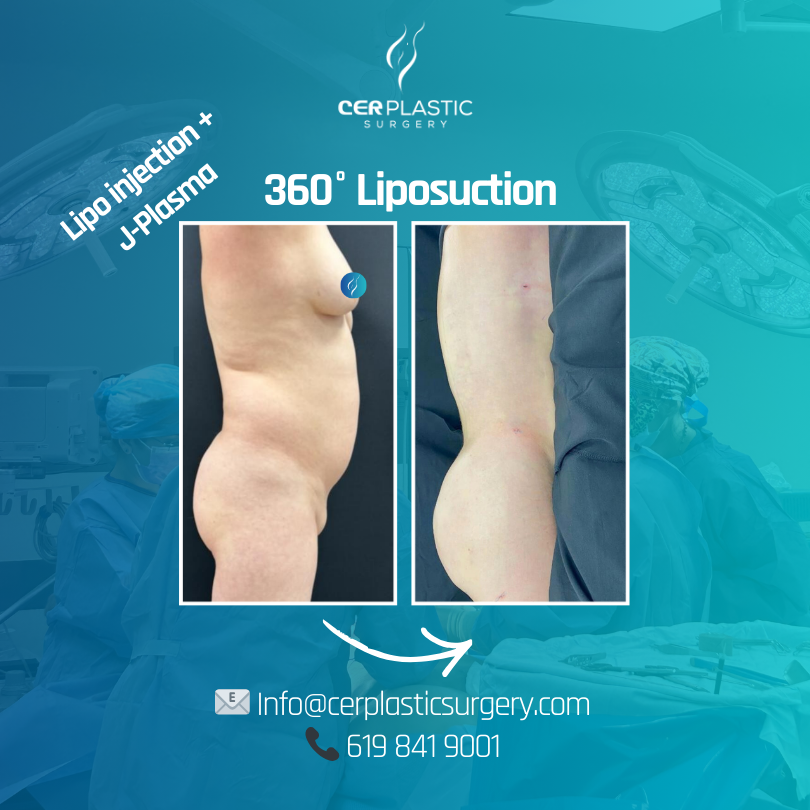 Image of a 360 liposuction