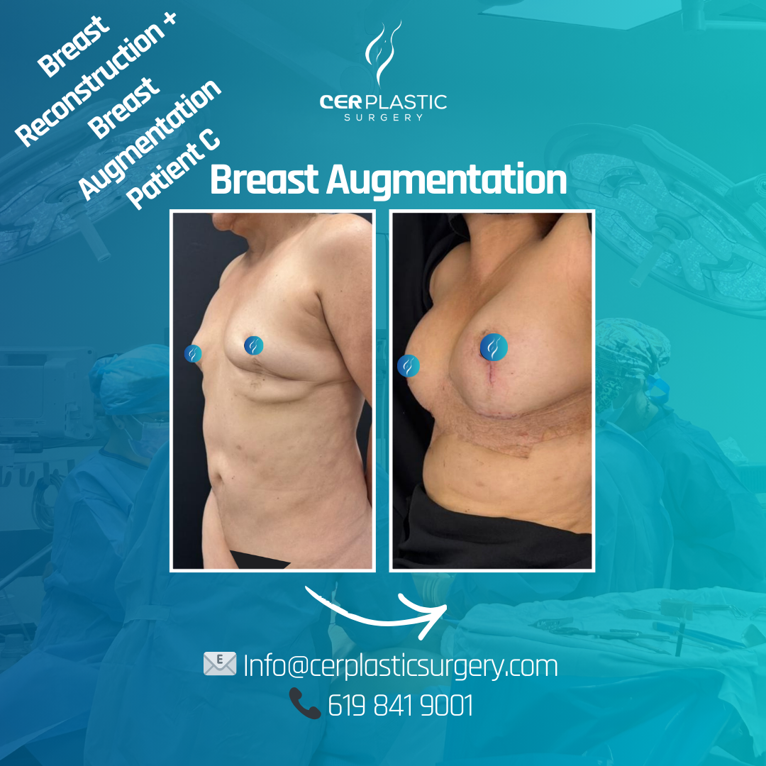 breast augmentation + breast reconstruction before and after