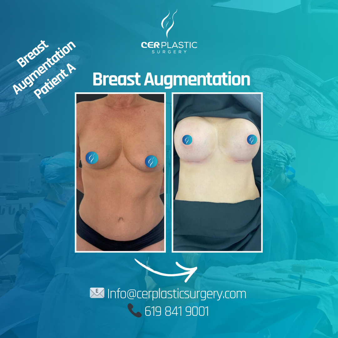 breast augmentation before and after