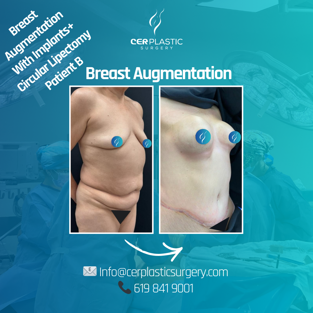 Breast augmentation with implants before and after
