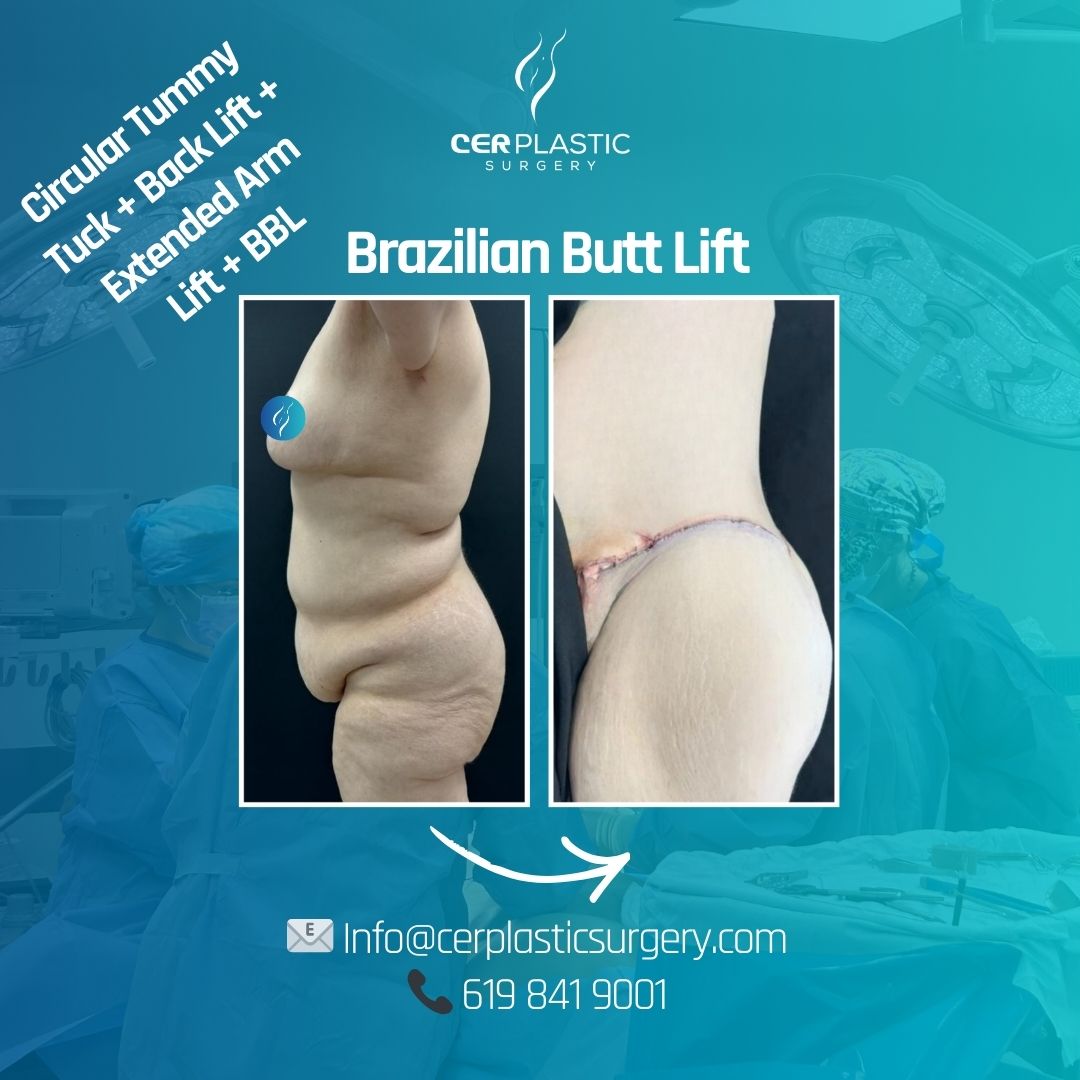 Tummy Tuck Patient B back side