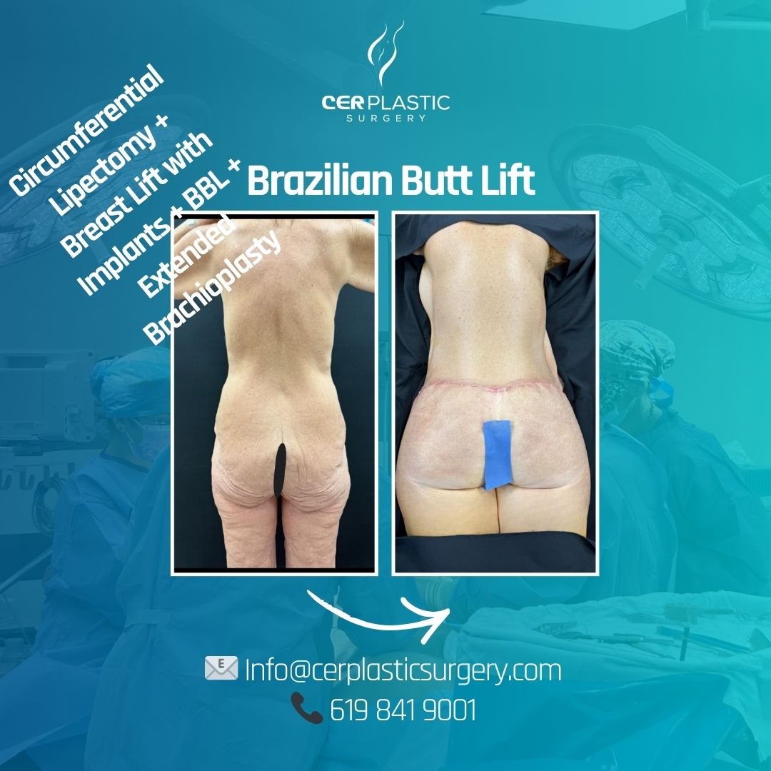 Tummy Tuck patient A front side plus extended thigh lift + breast lift with implants + torsoplasty