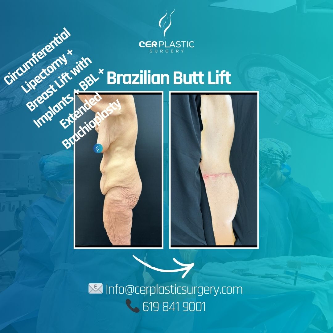 Tummy tuck patient before and after back side