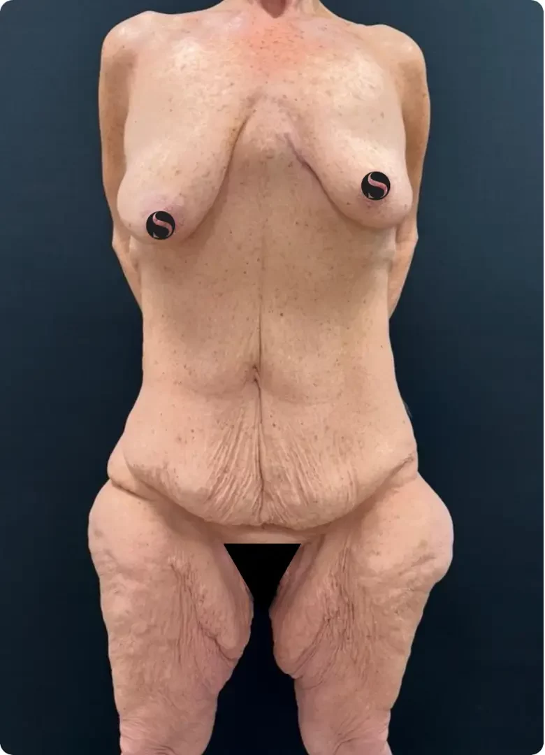 Before, example case