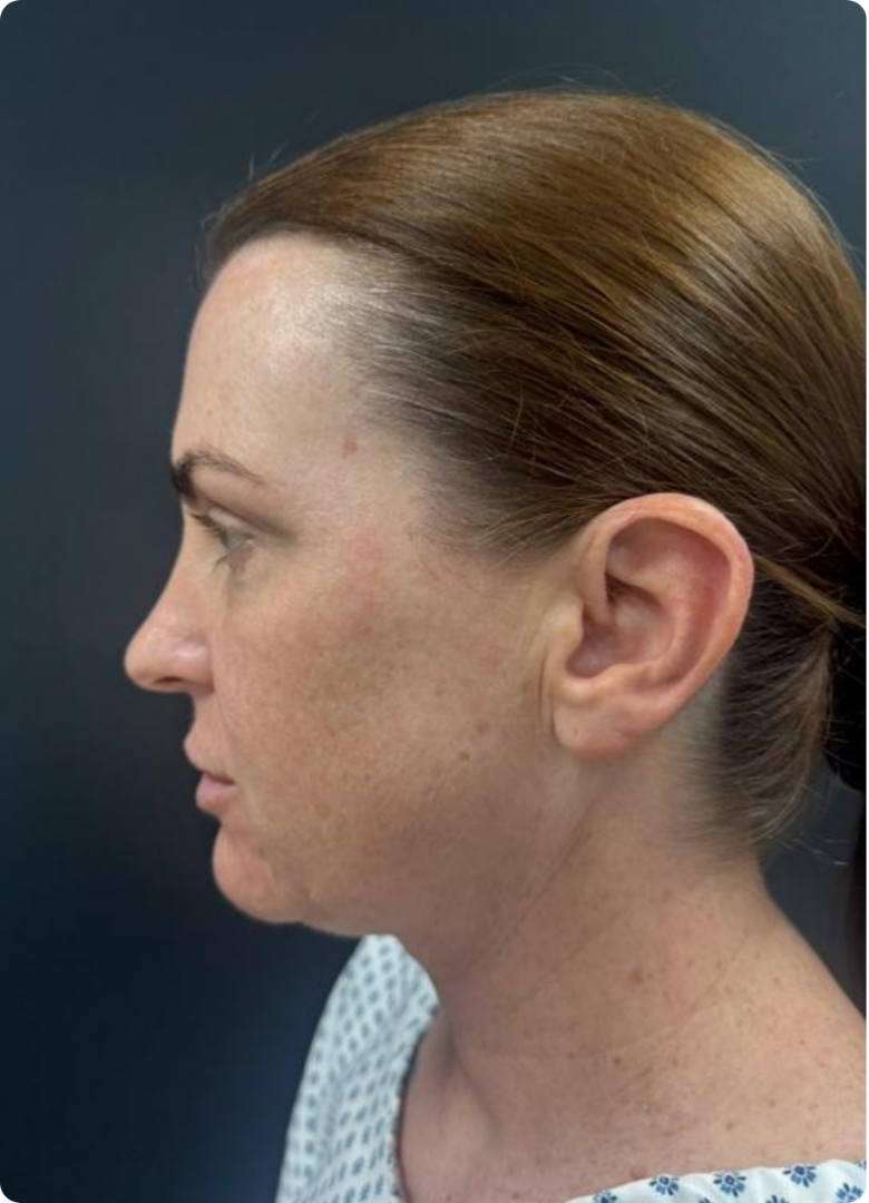 Before facelift surgery