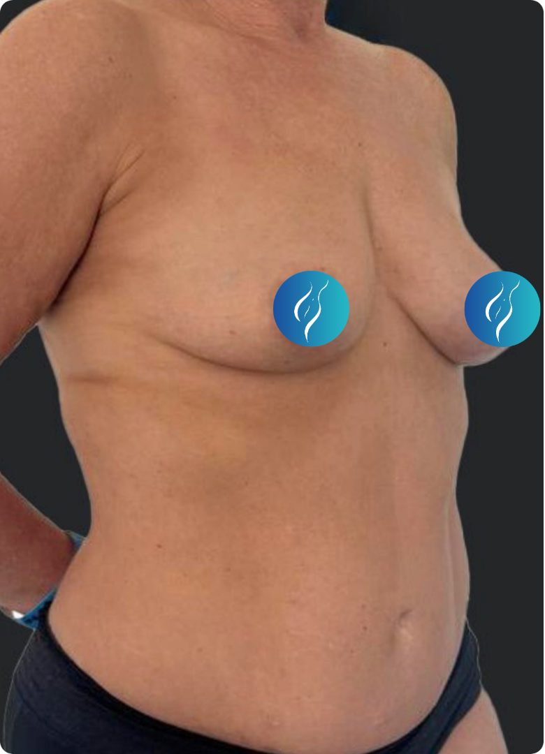 Before breast augmentation