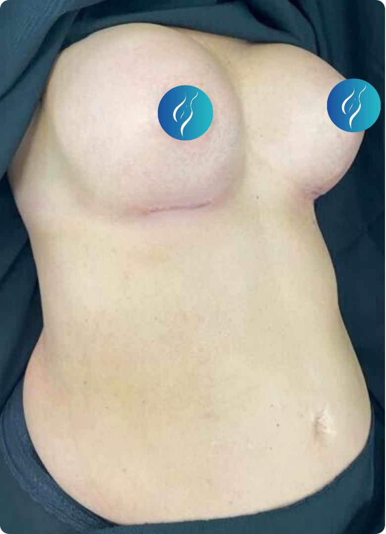 After breast augmentation