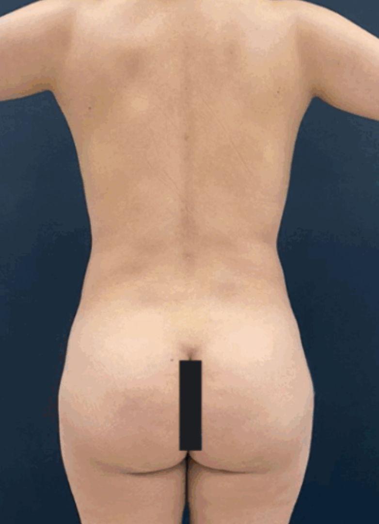 Before brazilian butt lift