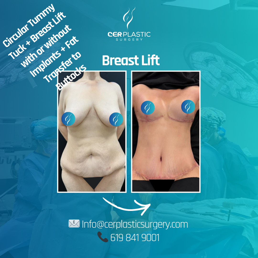 Breast lift front