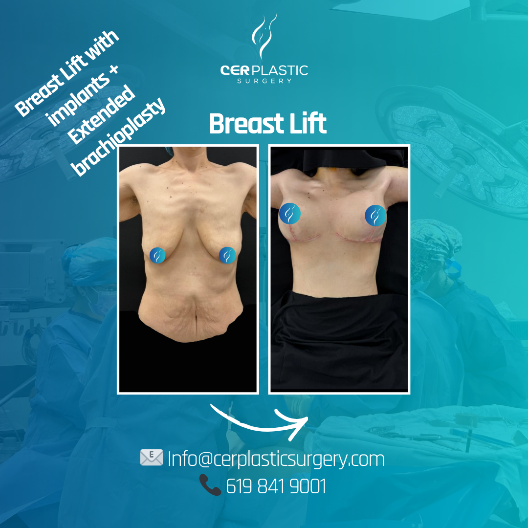 Breast lift front