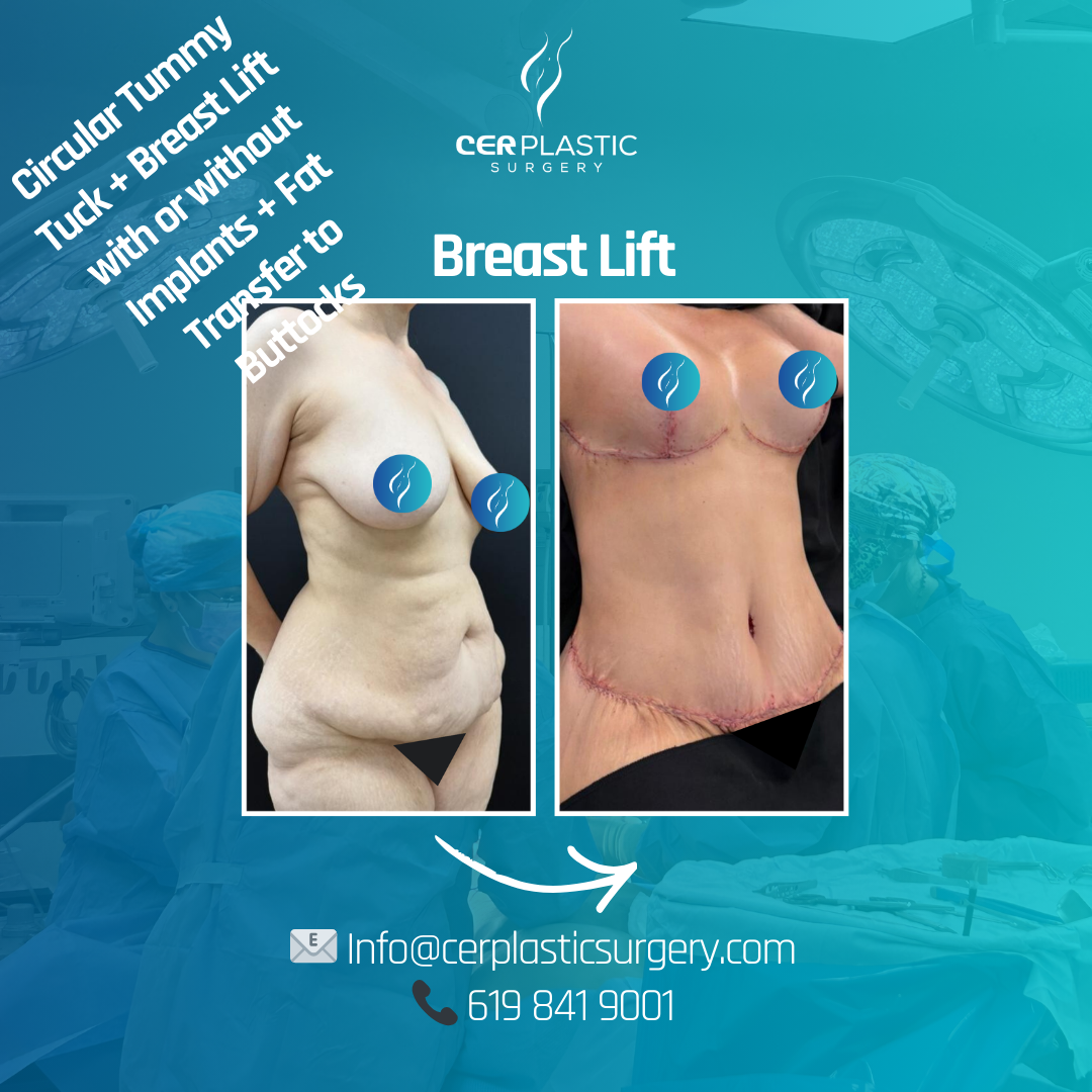 Breast lift side