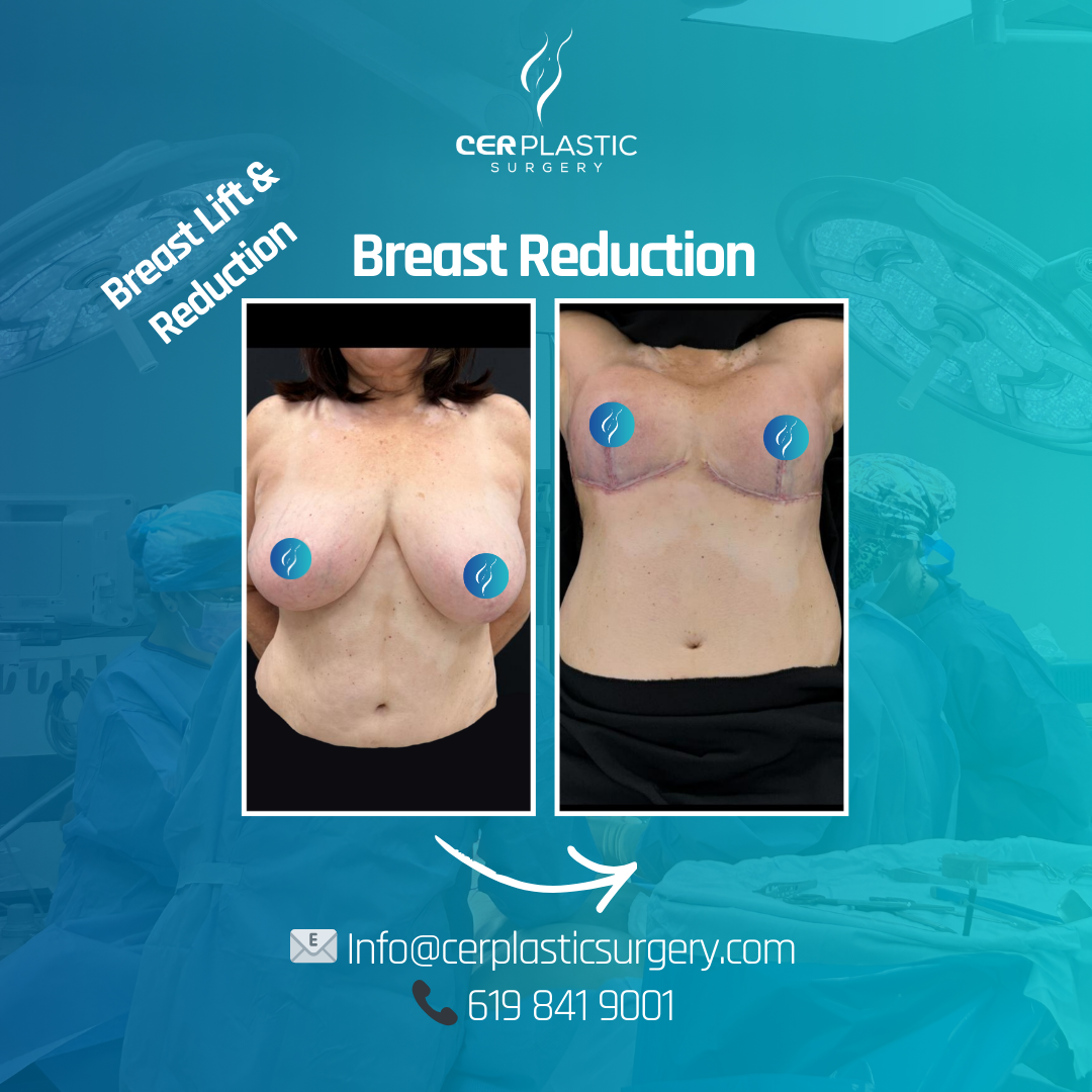 breast augmentation before and after