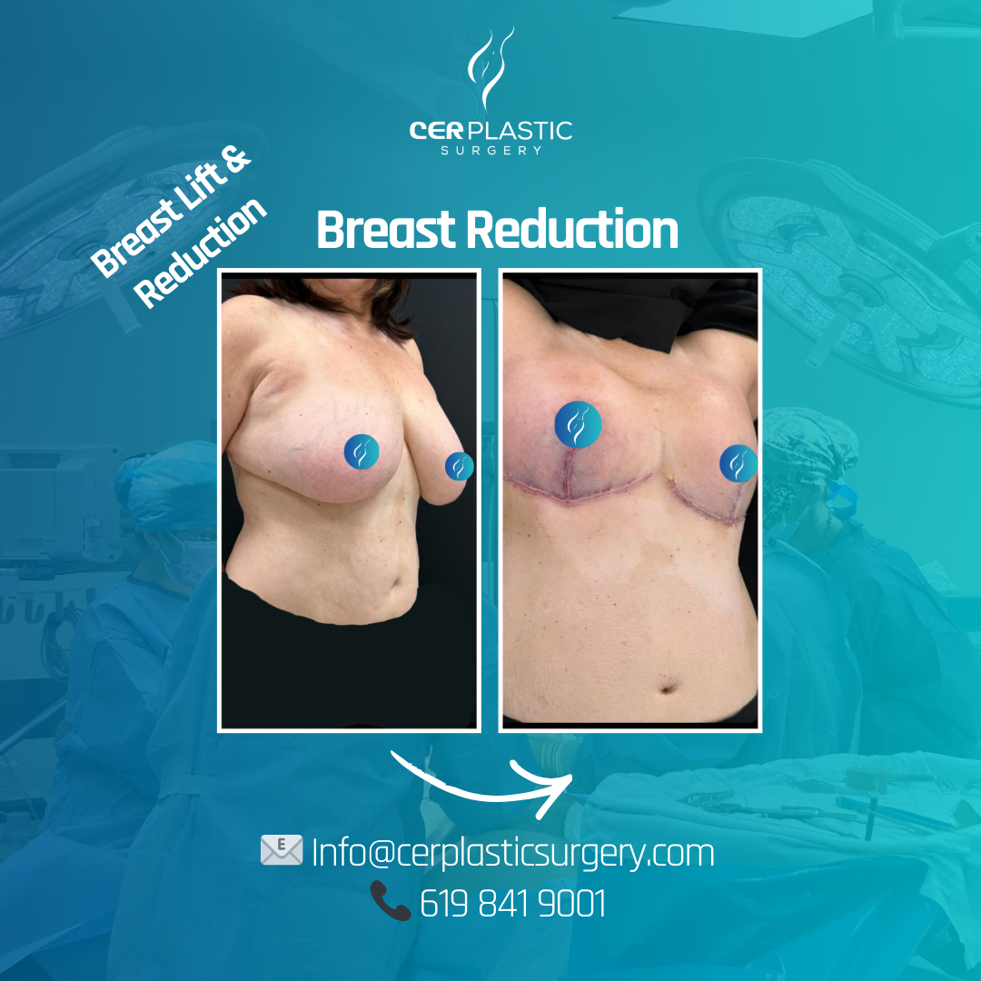 Breast augmentation with implants before and after