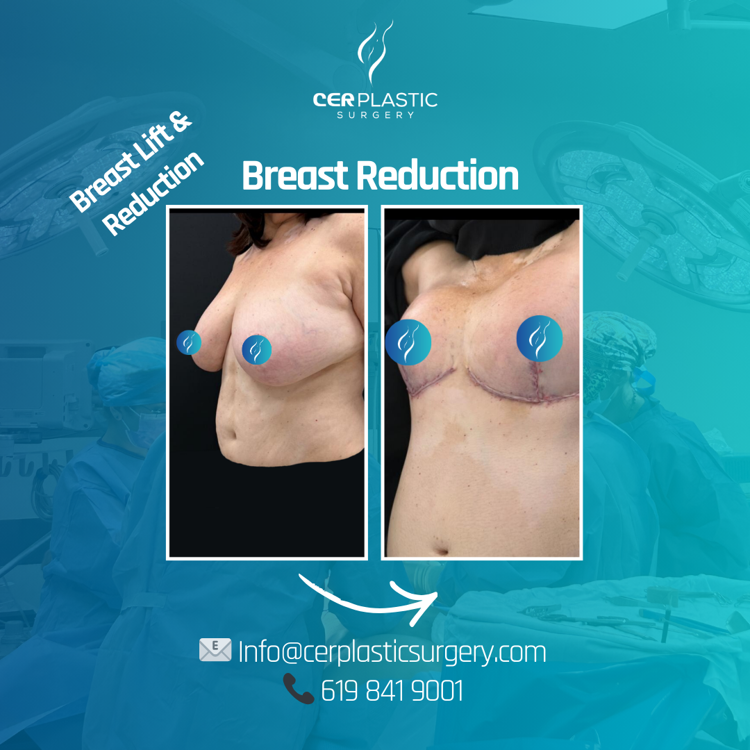 breast augmentation + breast reconstruction before and after