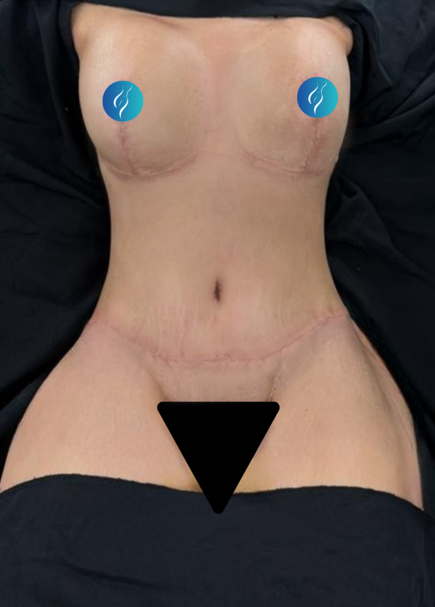 Mommy Makeover After surgery